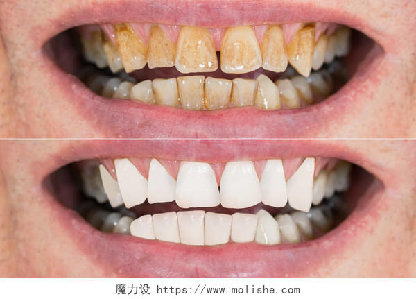 牙齿美白前后的特写细节牙齿美白口腔牙齿口腔牙齿